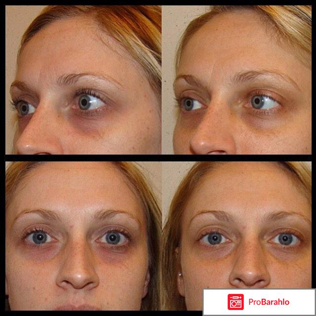 Гиалуронка под глаза отрицательные отзывы