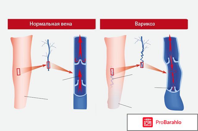 Варикоз отрицательные отзывы