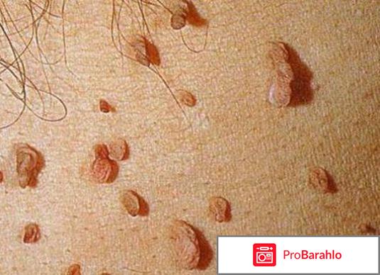 Papillock средство от папиллом и бородавок фото