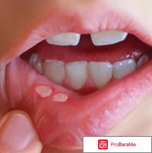 Стоматит: лечение у взрослых, фото, чем и как лечить отрицательные отзывы