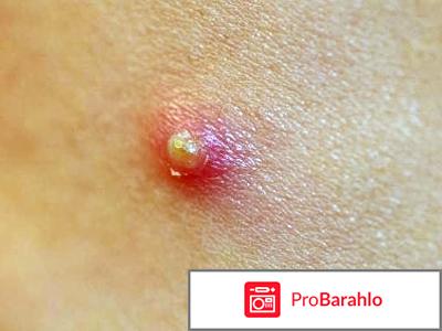 Лечение прыщей лазером отрицательные отзывы