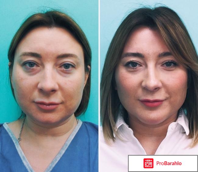 Липолитики отзывы фото до и после лицо отрицательные отзывы