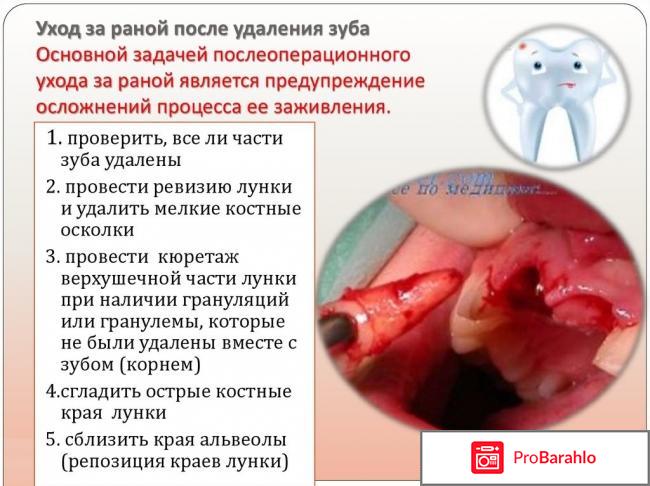 Уход после удаления зуба отрицательные отзывы