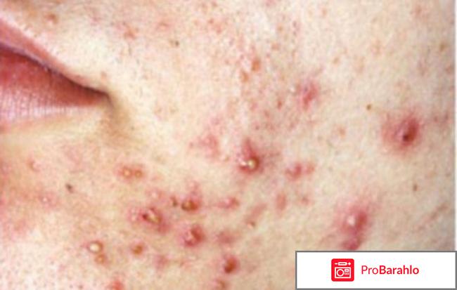 Либридерм сарацин от прыщей отрицательные отзывы