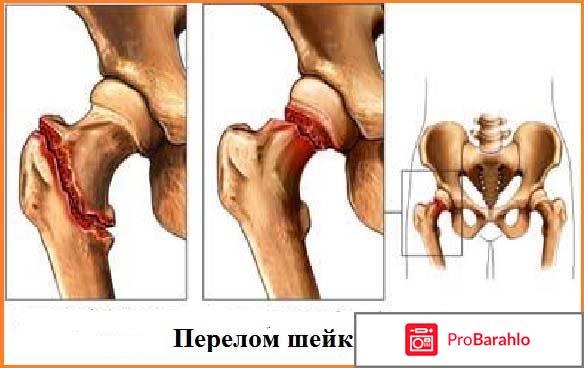 Пролиа отзывы врачей отрицательные отзывы