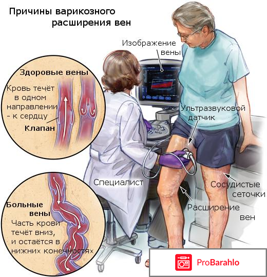 Вариоль - пенка от варикоза отрицательные отзывы