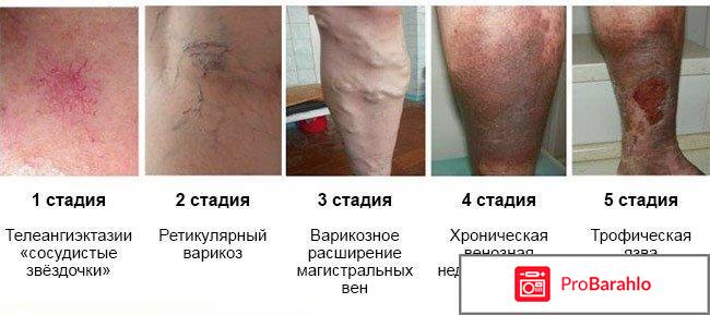 Венарус отзывы врачей