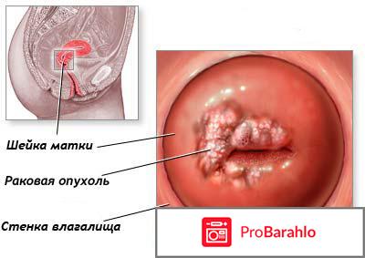 Вакцина от рака шейки матки 