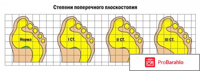 Поперечное плоскостопие симптомы и лечение 