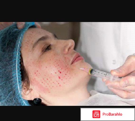 Мезотерапия: мой опыт отрицательные отзывы