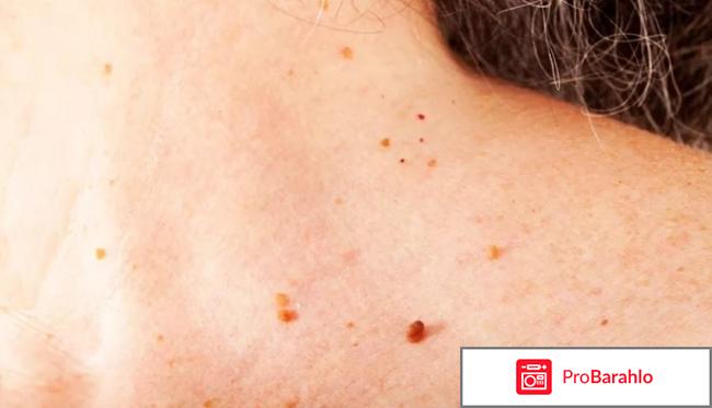 Виферон мазь от папиллом обман