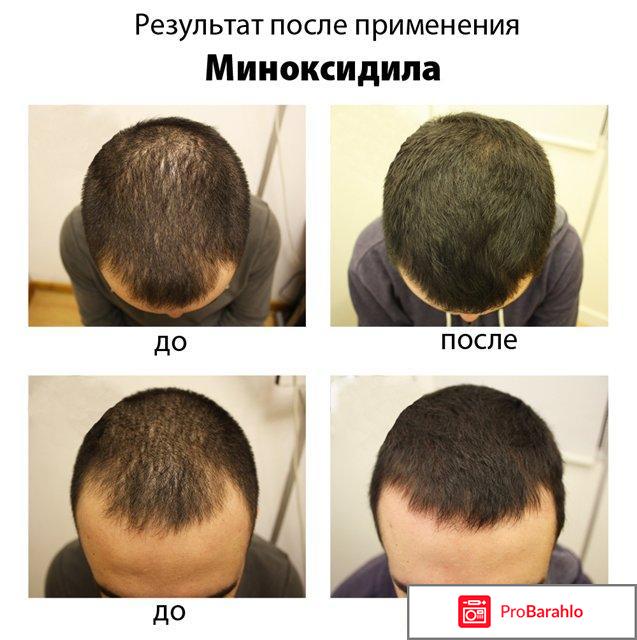 Minoxidil средство для волос