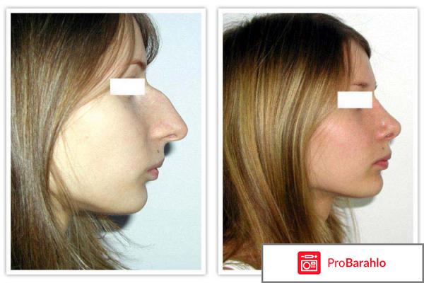 Пластика носа фото 