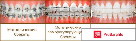 Установка брекетов 