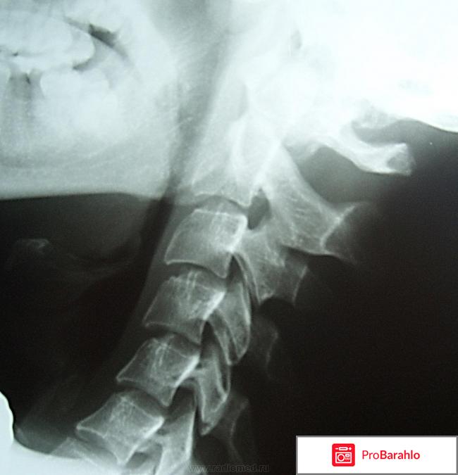 Аномалия киммерли как лечить обман