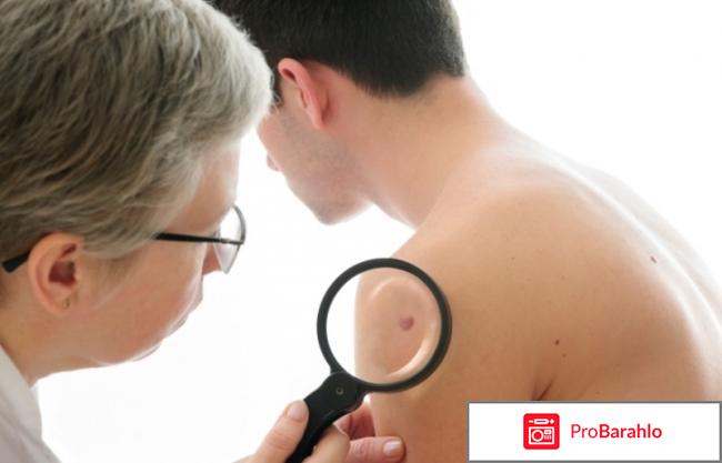 Отзывы людей больных меланомой 