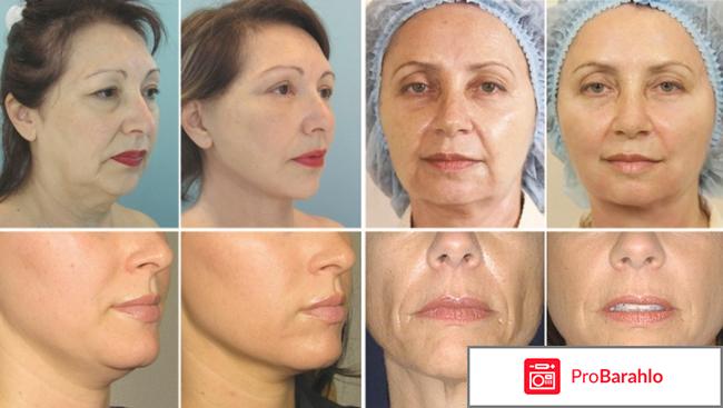 Мезонити отзывы негативные фото отрицательные отзывы