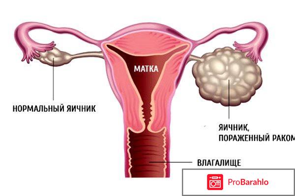 Са-125 онкомаркер расшифровка норма обман