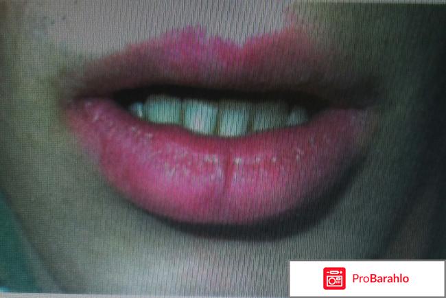 Хейлит. Раздражение. Причины возникновения. отрицательные отзывы