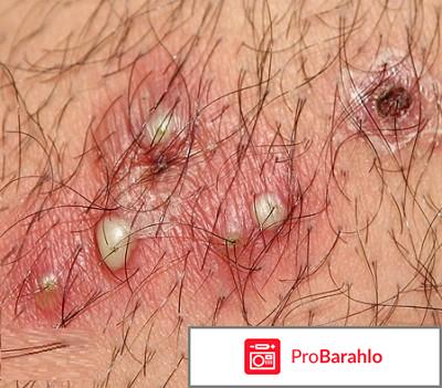 Воспаление волосяной луковицы отрицательные отзывы