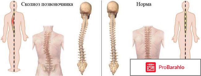 Операция на удаление сколиоза позвоночника 