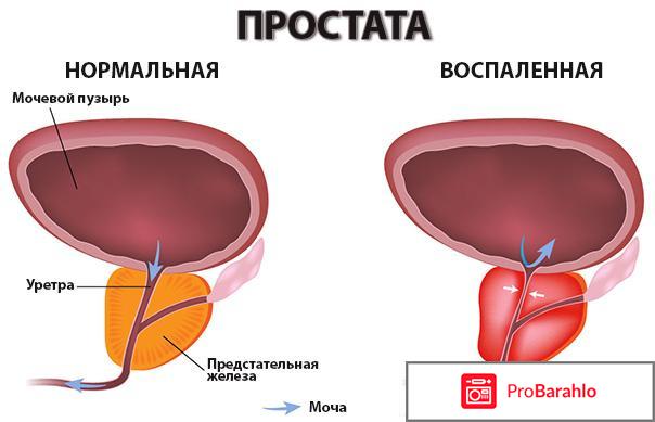 Просталайф для мужчин отзывы владельцев