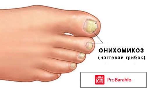 Мази от грибка ногтей 