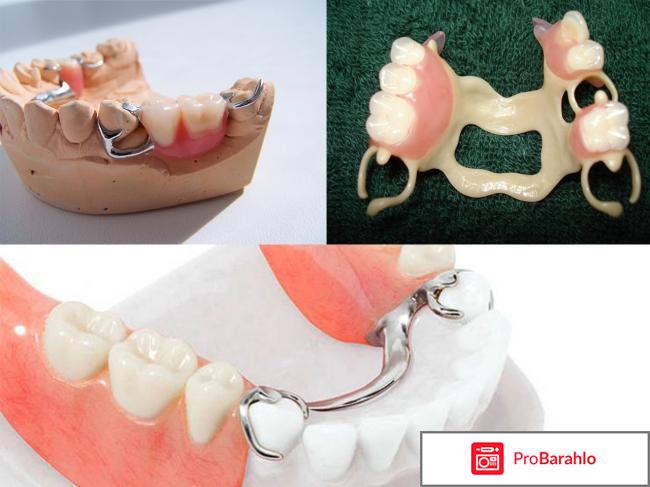 Какие зубные протезы лучше и дешевле отзывы отрицательные отзывы