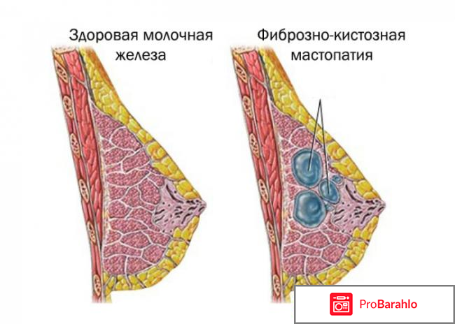 Huaxin Breast Plaster пластырь от мастопатии: цена обман