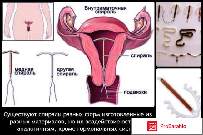 Спираль для женщин отзывы обман