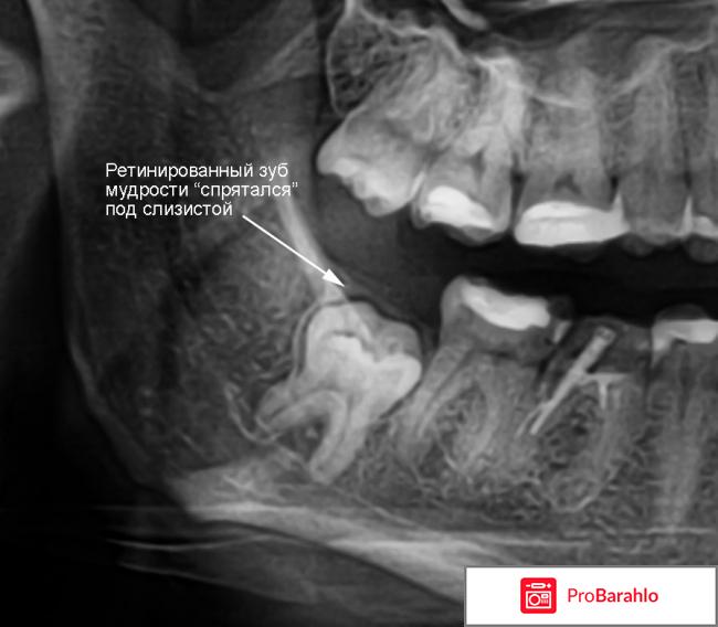 Удаление ретинированного зуба 