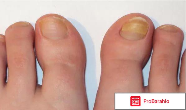 Офламилак от грибка ногтей цена отрицательные отзывы