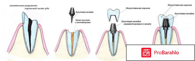 Керамическая коронка на зуб фото 