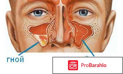 Антибиотики при гайморите отрицательные отзывы