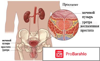 Отзывы о пиджеум от простатита отрицательные отзывы