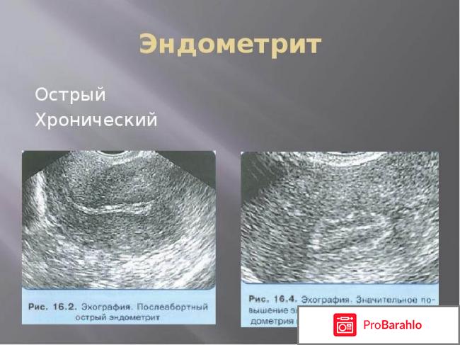 Эндометрит у женщин: виды, симптомы, лечение обман
