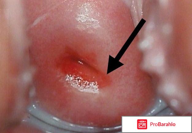 Лечение эррозии народными средствами 