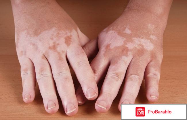 Как у меня получилось вылечить витилиго обман