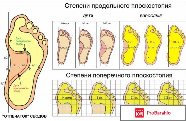 Плоскостопие операция отрицательные отзывы