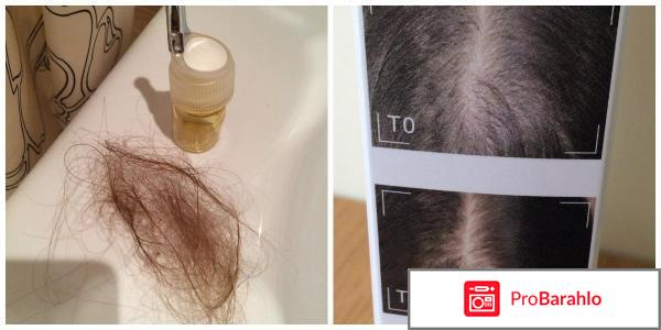 Ампулы от выпадения волос отзывы отрицательные отзывы