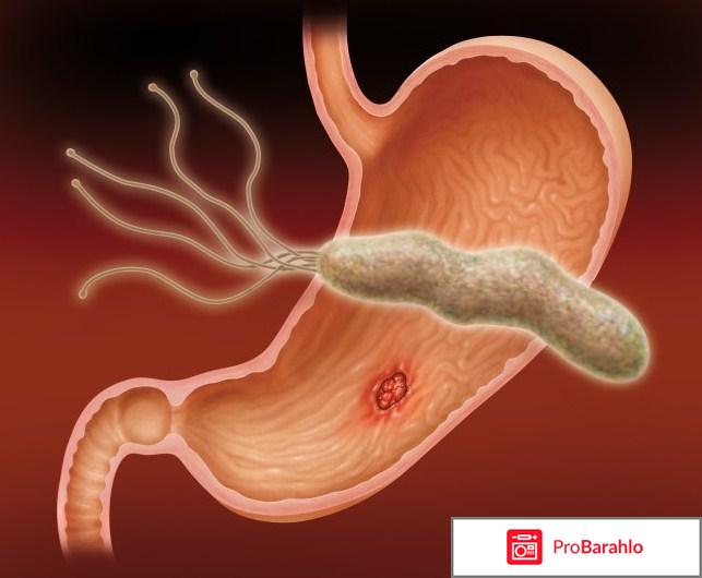 Прободная язва желудка 12 перстной кишки отрицательные отзывы