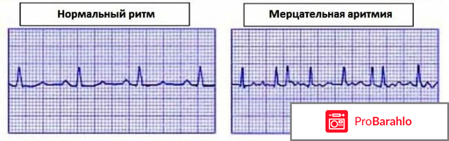 Ритмонорм инструкция по применению цена отзывы отрицательные отзывы