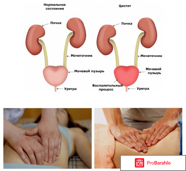 Цистит у женщин симптомы и лечение отзывы отрицательные отзывы