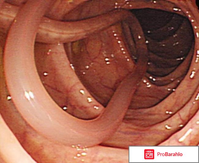 Gelmifort (Гельмифорт) отрицательные отзывы
