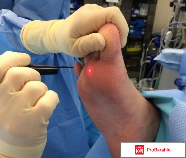 Удаление мозолей лазером отзывы реальные отзывы