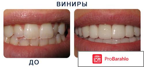 Виниры на зубы 