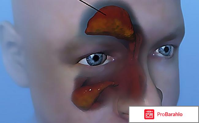 Из носа течет желтая жидкость что это 