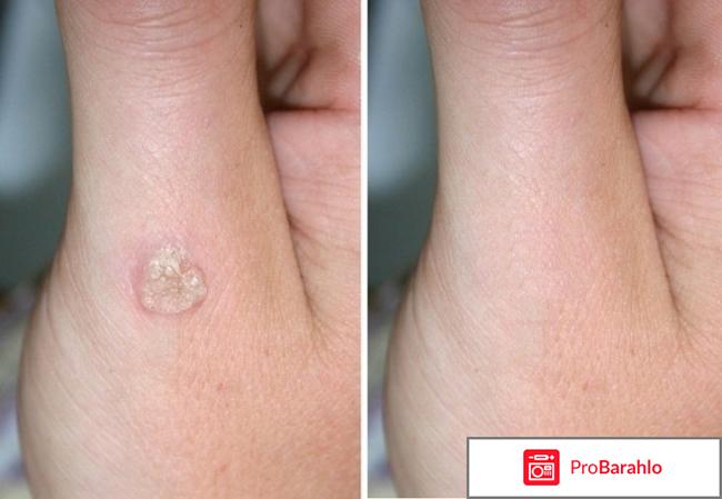 Папинол отзывы реальные 