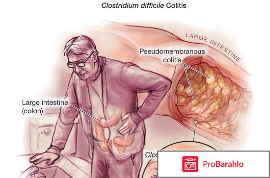 Дисбактериоз симптомы отрицательные отзывы