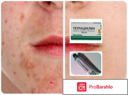 Тетрациклин мазь инструкция по применению цена отзывы обман